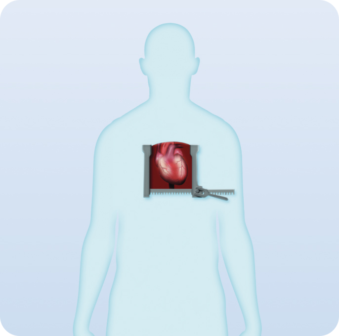 Surgical aortic valve replacement (SAVR)