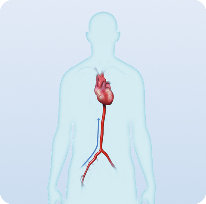 Transcatheter aortic valve replacement (TAVR)